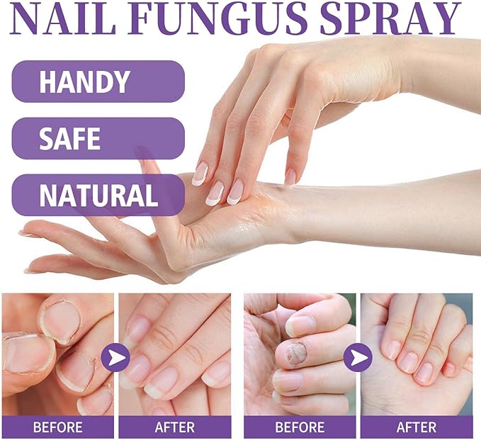 Gentle Nail Fungus Remover